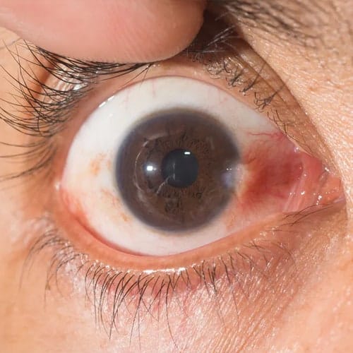 Cirugia Ocular Carnosidad