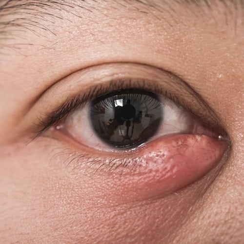 Cirugia Ocular Chalazion